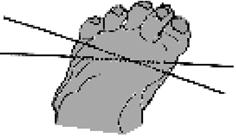 İkinci tel birinci metatars başı medial yüzünden sokulur ve ikinci metatarsı geçerek ayak dorsal yüzünde ortaya çıkar (Şekil 24a, b).