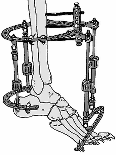 Ayak bileği ve ayak deformitelerinin İlizarov yöntemi ile tedavisi 223 Şekil 27. Tırpan osteotomisi 1-2 cm osteotom kullanılarak küçük bir insizyon ile de yapılabilir.