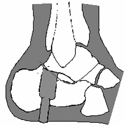 Kalkaneustan geçirilen teller ayak bileği eklemi distraksiyonunun yapılmasında işe yarar. Metatarsal tel ve ön ayaktaki yarım halka ekinus deformitesinin düzeltilmesinde kullanılır.
