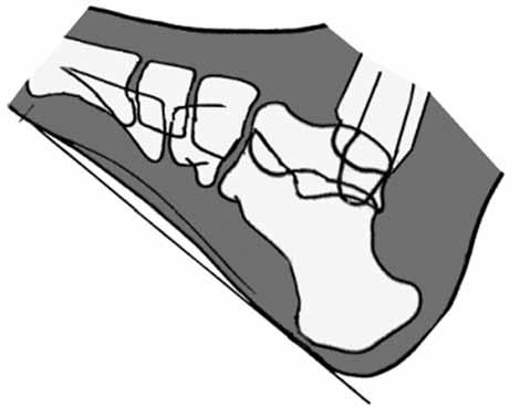 Klinik İlerleyici olmayan kavus deformiteli hastalar, parmakların pençeleşmesinden ve ayakkabı deformasyonundan yakınırlar.