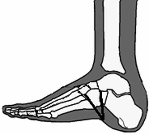 Ayak bileği ve ayak deformitelerinin İlizarov yöntemi ile tedavisi 227 Şekil 35. Talus ekseni normalde birinci metatars ekseni ile çakışır, aralarında açı yoktur. ayak pozisyonu değerlendirilir.