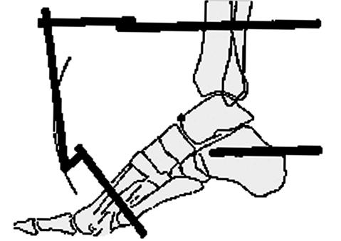 Diğer yarım çember tibia longitudinal eksenine dik olarak kalkaneusa yerleştirilir (Şekil 40). Kalkaneus iki veya üç adet stoplu K-teli ile ayak çerçevesine tespit edilir.