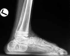 4- Pes Kalkaneus Tanım Hastanın topuk üzerine basarak yürümesine ve yürürken ayağın ön bölümünün yere temas etmemesine denir.