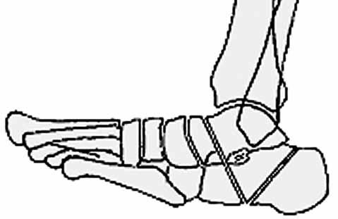 Ayak bileği ve ayak deformitelerinin İlizarov yöntemi ile tedavisi 235 Şekil 57. (a, b) Pes planusta açık kama osteotomisi ile ayak kavisinin oluşturulması. 1.
