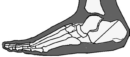 Ayak ve ayak bileği yapılarındaki kontraktür nedeniyle plantar fleksiyon kısıtlıdır. 2. Pes kalkaneus: Dinamik bir deformitedir.