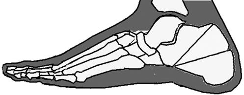Pes kavus posteriyor tipi: Kalkaneus deformitesi pes kalkaneusda olduğu gibidir. Ancak ondan farkı ayağın yere düz olarak basmasıdır.