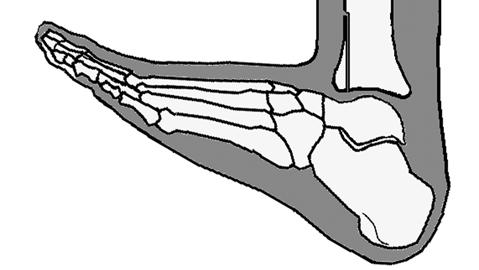 Ayak dorsifleksörlerinin gücü ise normaldir. Bu deformiteler osteotomilerle düzeltilemez. Ancak bozulmuş olan kas dengesinin yeniden kurulmasıyla düzeltilebilir.