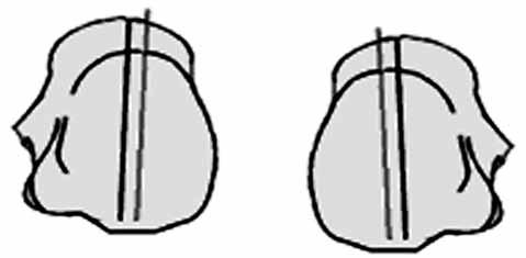 noktasının tibia longitudinal ekseninin medialinde durmasına topuk varus deformitesi denir. Etyoloji Kalkaneus varus deformitesi primer veya sekonder olarak gelişir.