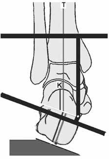 Ayak bileği ve ayak deformitelerinin İlizarov yöntemi ile tedavisi 239 Şekil 69. (a, b) Topuk valgus deformitesi ve açık kama osteotomisi ile tedavisi.