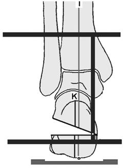 Buradan kaynaklanan deformiteler bile ön ve arka ayakta deformiteye neden olur. Ön ayak deformiteleri sıklıkla sagittal veya horizontal planda oluşur.