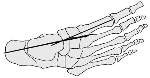 Ayağın medial kısmı içbükey, lateral kısmı ise dışbükey bir eğrilik şeklindedir. Klinik Üç tipi vardır: 1. Aktif olarak düzeltilebilir. 2. Pasif olarak düzeltilebilir. 3.