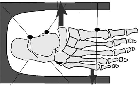 Ön ayak abdüksiyon deformitesi Ekinovalgus ve vertikal talus deformitesinde görülür. Bu deformitede kapalı ve açık tedavi yöntemi uygulanır.