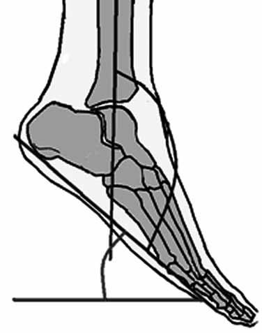 Ayak bileği ve ayak deformitelerinin İlizarov yöntemi ile tedavisi 2. Frontal plan deformiteleri a) Topuk varusu. b) Topuk valgusu. 3. Horizontal plan deformiteleri a) Ön ayak abdüksiyon deformitesi.