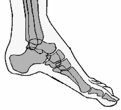 Gerçek ekinus deformitesinde kalkaneus ve talus da deformiteye katılır ve kalkaneus distal ucu (Küboid ile eklem yapan ucu) aşağı yöne doğru (Plantar fleksiyon yönünde), proksimal ucu ise tersine