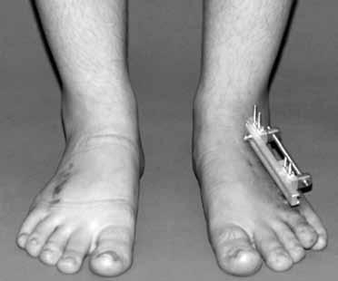 242 TOTBİD Dergisi (c) Şekil 76. Sağ 4. metatarsı daha önce uzatılmış olan hastanın sol tarafı uzatılmakta. Her iki ayağın uzatma esnasındaki radyografik görünümü.