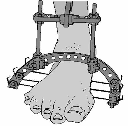 Metatarsal yarım halkanın her iki ucunu birleştiren çizgi metatars başları bölgesinde ayak tabanına paralel olmalıdır. Deformite düzeltildikten sonra. tabanlıklarla bastırılmalıdır.