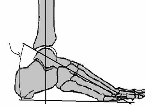Ayak bileği ve ayak deformitelerinin İlizarov yöntemi ile tedavisi 217 110 115 Şekil 8. Tibia-1. metatars açısı. Tibiokalkaneal açının normal dereceleri görülüyor.