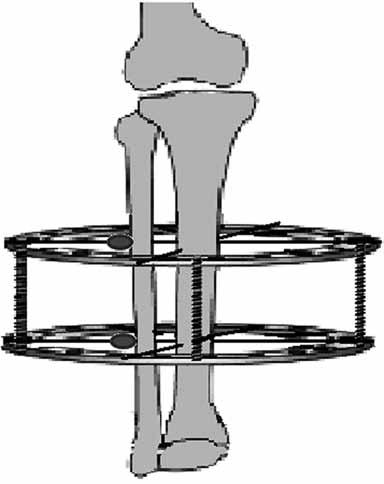 Bu esnada cerrah diğer eli ile ayağı maksimum dorsifleksiyonda tutar. Tendon kesilince ayak dorsifleksiyonunda artış olur. Ayak dorsifleksiyonu zorlanarak artırılmaya çalışılır.