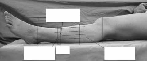 Soleus kasının gastroknemiusa yapışma yeri V şeklinde kesilir. Ayak dorsifleksiyona zorlanır. Dorsifleksiyona zorlandığında planlanan düzeltme sağlanıyorsa ekstremite alçıya alınır ve 1.
