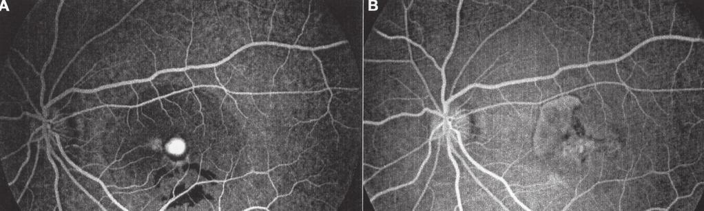 Ret-Vit 2006;14:161-168 83 Resim 3: Subfoveal koroid neovaskülarizasyonunda fundus floresein angiografi görüntüleri. A. İVTA öncesi, B. İVTA sonrası.