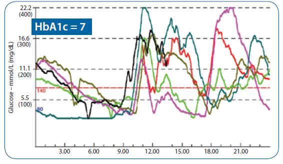 HbA1c ve SMBG her zaman resmin bütününü gösterir mi? Kabul edilebilir HbA1c değerleri ile bile hastalar glisemik değişkenlik yaşayabilir.