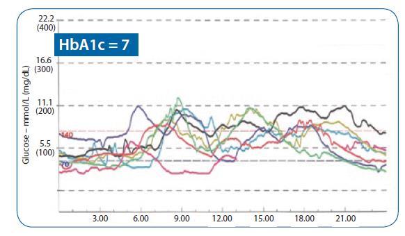 CGM; İlaçlar ve aktiviteler glikoz değerlerini nasıl etkiliyor incelememizi sağlar CGM; Etkin tedavi dozları ayarlamak için olanak sağlar 1 Pitzer