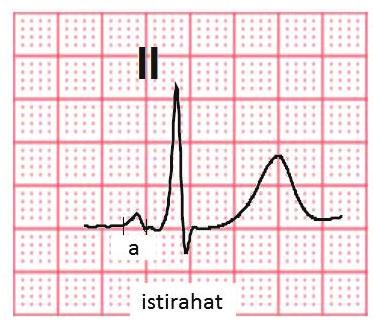 Kangül H, Eyüboğlu M, Kozan Ö. Koşuyolu Heart J 2017;20(2):111-115 113 Şekil 1. P dalga dispersiyonu ölçümü. BULGULAR Çalışmaya 126 hasta dahil edildi ve çoğunluğu (%58.7) erkek hastalardı.