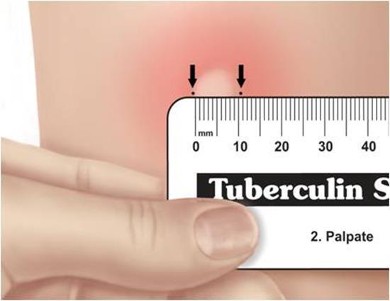 TST Yorumlanması BCG (+) 0-5 mm Negatif 6-14 mm BCG pozitifliği 15 mm ve üzeri Pozitif, infeksiyon (+) İmmünyetmezlik olgularında 5 mm