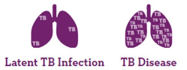 Latent TB / Pulmoner TB Hastalığı Dünya nüfusunun 3 te biri LTBI Latent TB Enfeksiyonu Pozitive TDT veya IGRA sonucu Gögüs filmi normal