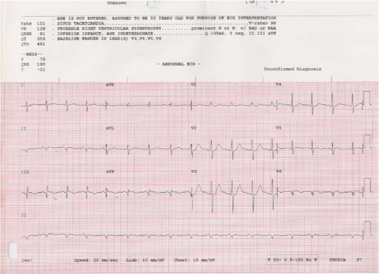 -AYIRICI TANI- Soru 2: Başvuru EKG sindeki V1 deki pozitif R dalgasındaki primer tanı nedir?