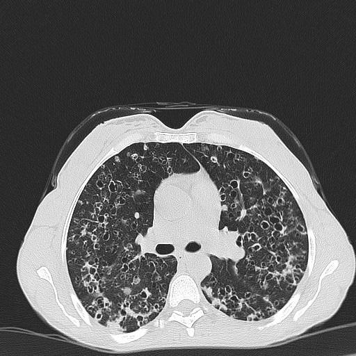 Posteroanterior akciğer grafisinde bilateral kostodiafragmatik sinüsler korunmuş, her iki akciğerde retikülonodüler opasite artışı mevcuttu (Resim 1). Yapılan solunum fonksiyon testinde (SFT) 1.
