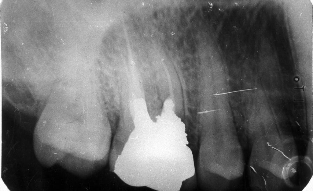 112 EBRU ÖZSEZER-AYŞİM AKMAN Resim 3: Dişin 30. aydaki radyolojik görüntüsü. K-tipi eğeler ile prepare edildi. Her eğeden sonra kanallar % 5.
