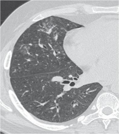 Wegener granülomatozis akciğer tutulumunda bilgisayarlı tomografi bulguları: Resimlerle bir konu Resim 4. Aktif Wegener granülomatozisli 21 yaşında erkek hasta.