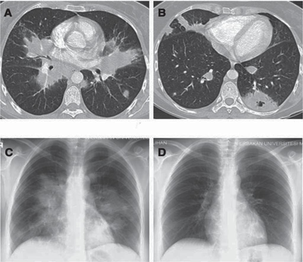 Wegener granülomatozis akciğer tutulumunda bilgisayarlı tomografi bulguları: Resimlerle bir konu Resim 9. 34 yaşında kadın hasta aktif Wegener granülomatozisli.