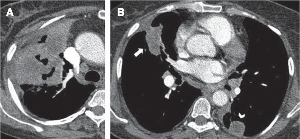 Tedavi öncesi (C) ve sonrası (D) çekilmiş akciğer grafilerinde lezyonların kaybolduğu görülüyor. Resim 10. 52 yaşında kadın hasta, nefes darlığı olan aktif WG hastası.