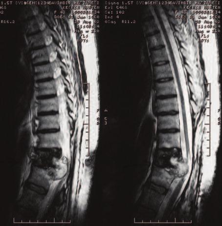 RESİM : T ağırlıklı sagittal kesitte T vertebra korpusunda ekspansil destrüksiyona yol açan spinal kordu basılandıran yumuşak doku kitle lezyonu.
