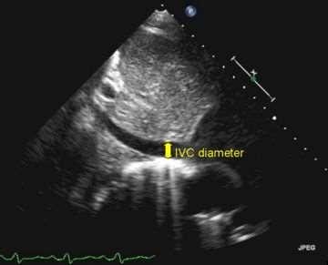 İNFERİOR VENA KAVA ÇAPI ÖLÇÜMÜ (IVCD) IVC çapı