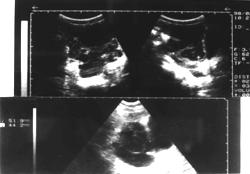 OLGU Son bir aydır ateş, halsizlik, kilo kaybı, karın şişkinliği yakınmaları olan 11 yaşındaki kız hastanın ultrasonografisinde (US); batında asit, sağ over lojuna uyan bölgede solid ve kistik