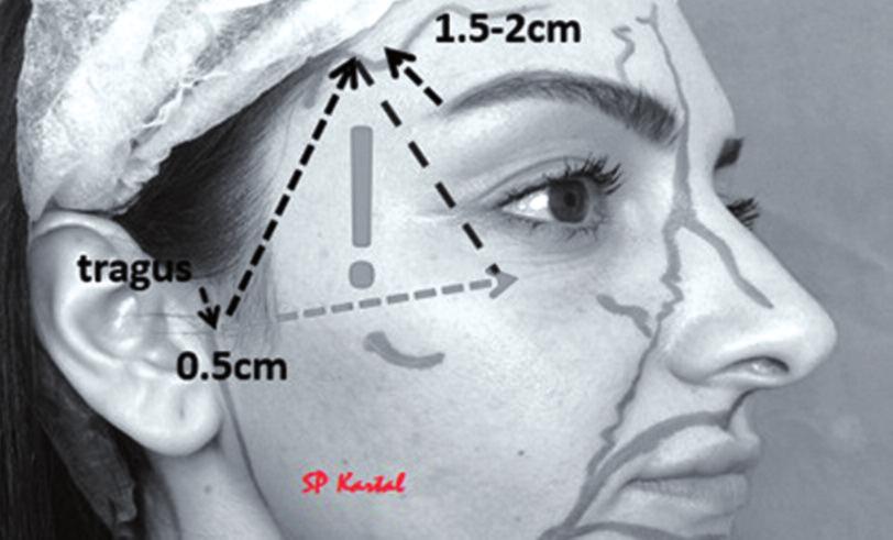 Selda Pelin KARTAL Turkiye Klinikleri J Cosm Dermatol-Special Topics 2017;10(3):158-64 YAĞ YASTIKLARI Yüzdeki