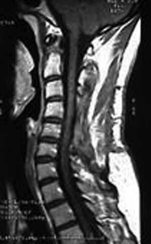 melanotik schwannoma tanısı almıştı (4).