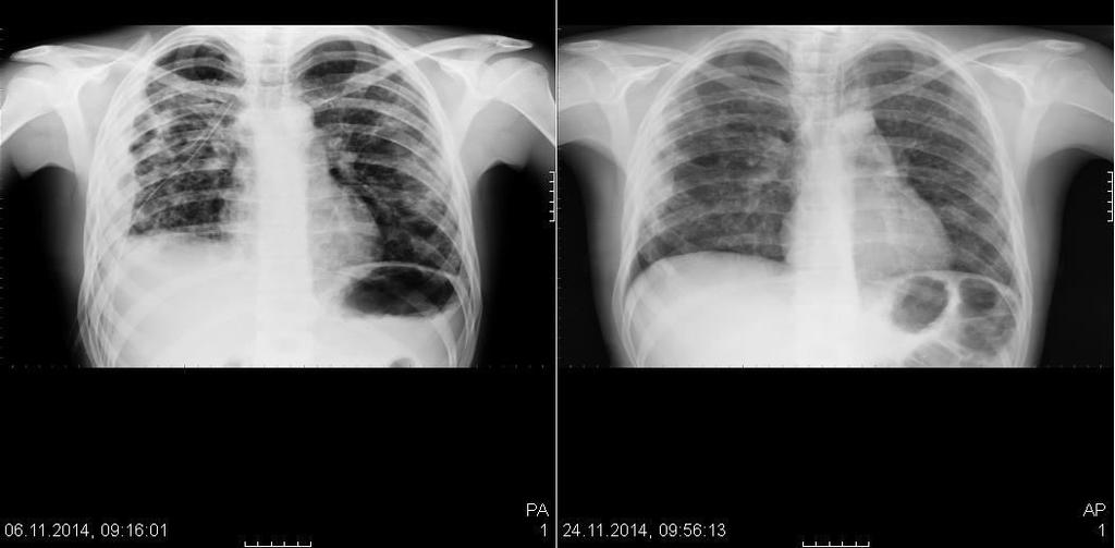 Hastamızın akciğer grafileri Geliş