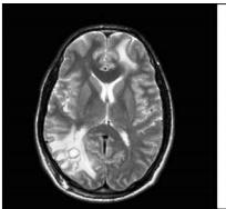 Olgu-1 Manyetik rezonans görüntüleme (MRI) de; Sağ parietal