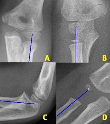 Dadı Dirseği (Radius başı çıkığı) < 5 yaş altı çocuklarda en