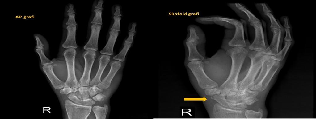 Skafoid Fraktürleri Direkt grafilerin yaklaģık %20 si normal Distal radiustan sonra el bileğinin en sık kırılan kemiği, tüm karpal kemik kırıklarının % 70-80 i Anatomik enfiye çukurunda ağrı