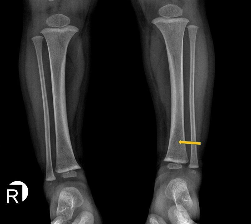 TODDLER Kırığı Hastaların üçte birinden fazlasında ilk radyolojik incelemelerde kırık bulgusuna rastlanmaz ya da gözden kaçar 9 ay-3 yaş arasında yeni