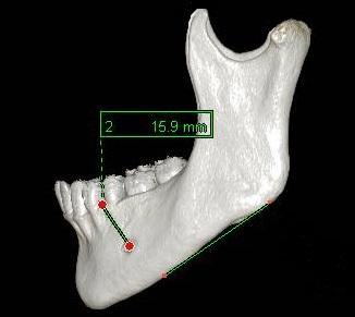 A), (Resim 2. 4 B). A B Resim 2. 4. Foramen mentale nin corpus mandibulae nın üst kenarına uzaklığı.