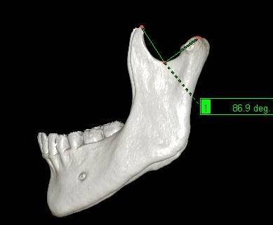 Proc. condylaris-inc. mandibulae-proc. coronoideus (AÇI 2) açısı; lateral pozisyonda proc. condylaris in en üst noktası, inc. mandibulae nın alt noktası, proc.