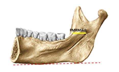 kenarının en derin noktasından) ile linea obliqua interna (ramus mandibulae nın ön kenarında bulunan) arasındaki mesafe (Resim 2.14 A), (Resim 2.14 B). A B Resim 2.14. For.