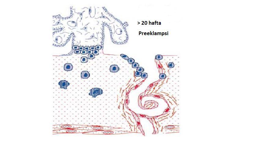 Preeklampside yetersiz trofoblast invazyonu Sağlıklı bir gebelik için yeterli trofoblastik invazyon şarttır.