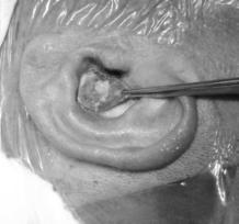 Konkal cilt flebinin, konkal kartilajın perikondrial katı üzerinden keskin diseksiyonla ayrımış görünümü. Tüm ol gu la ra 10 gün sü rey le ge niş spek trum lu anti bi yo tik ve ril miş tir.